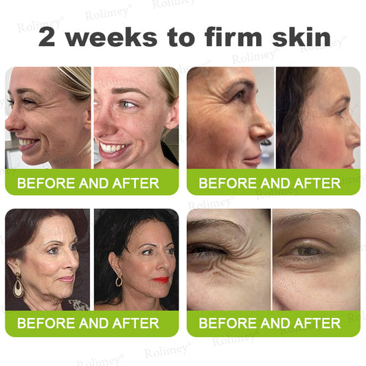 up-[🔥Last Day 70% OFF] ODALIT™ Botox & Retinol Shot - Eraser for Deep Wrinkles, Sagging Jowls & Puffy Eyes